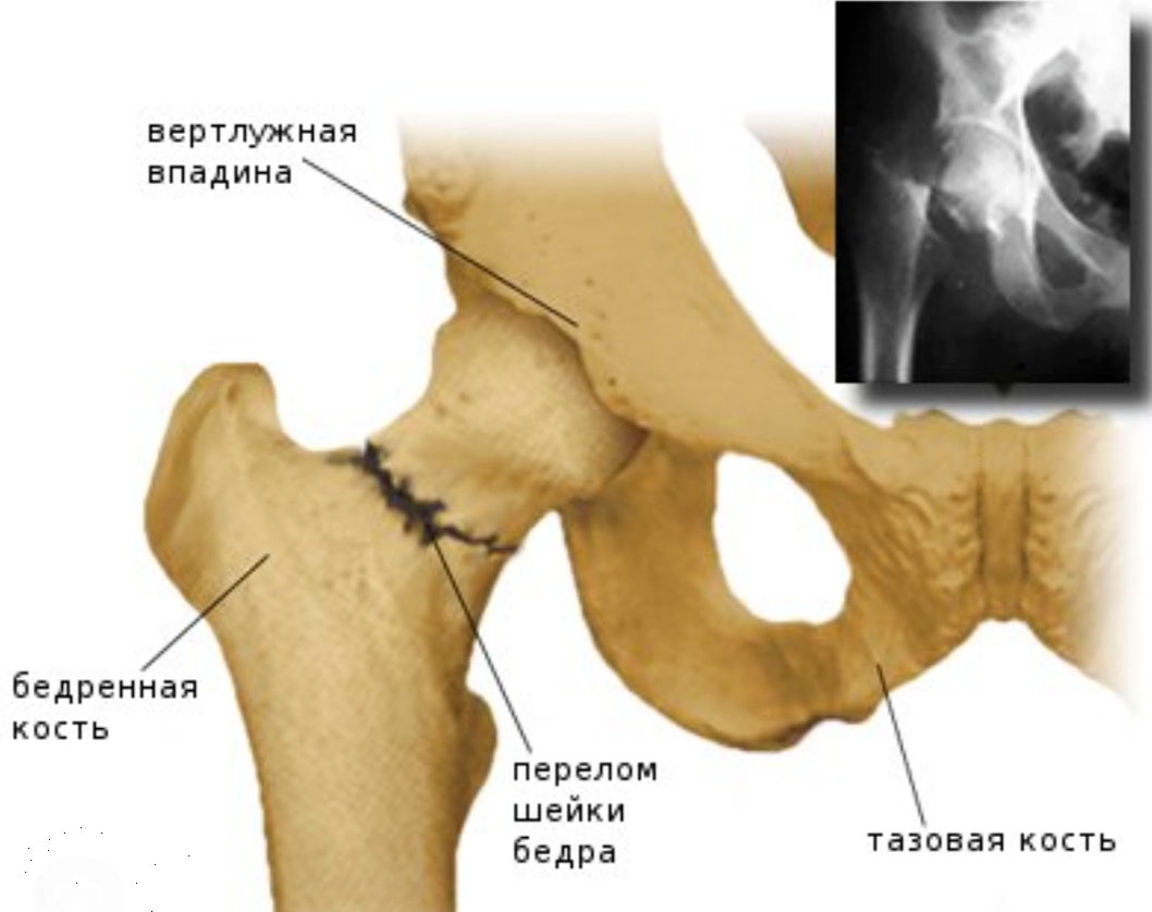 Перелом шейки бедра